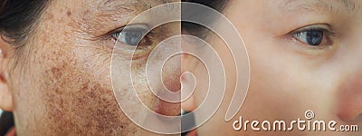 Problem skincare and health concept. wrinkles, melasma, dark spots, freckles, dry skin on face middle age women. Stock Photo