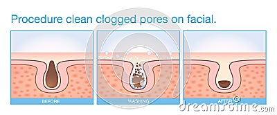 Procedure clean clogged pores on facial. Vector Illustration