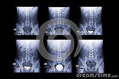 procedure of Intravenous pyelogram or I.V.P. Stock Photo
