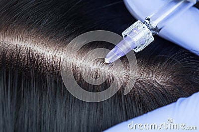 Procedure of mesotherapy. The doctor cosmetologist makes the procedure of mesotherapy in woman`s head. Stock Photo