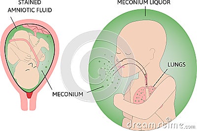 The process of Meconium aspiration syndrome MAS also known as neonatal aspiration of meconium. Fetus in womb. Mecinium Vector Illustration