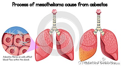 Process of mesothelioma cause of asbestos Vector Illustration