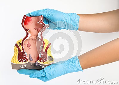 Proctologist holding anatomical model of rectum with hemorrhoids isolated on white Stock Photo