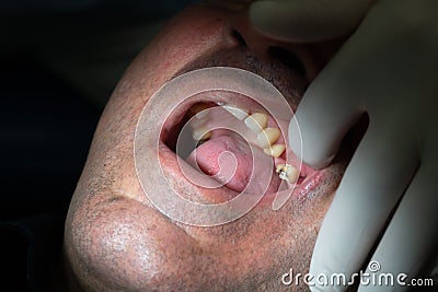 Dental implantation Stock Photo