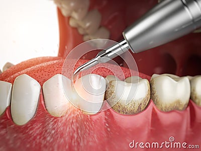 Professional teeth cleaning. Ultrasonic teeth cleaning machine d Cartoon Illustration