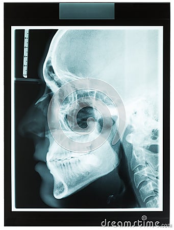 Profile xray of man jaw for dentist Stock Photo