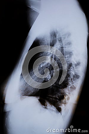 Profile XRay of a woman`s chest Stock Photo