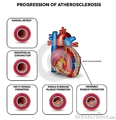 Progression of Atherosclerosis Vector Illustration