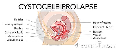 Prolapse cystocele Female reproductive system uterus with inscriptions text. Side view Human anatomy internal organs Vector Illustration