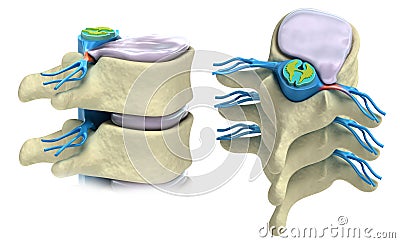 Prolapse of intervertebral disc Stock Photo