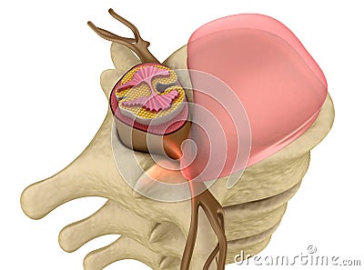 Prolapse of intervertebral disc closeup Stock Photo