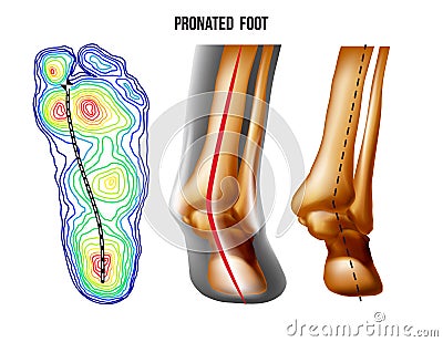 Pronated foot, arch deformation, bottom and back view . Foot weight distribution. Vector Illustration