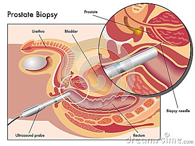 Prostate biopsy Vector Illustration