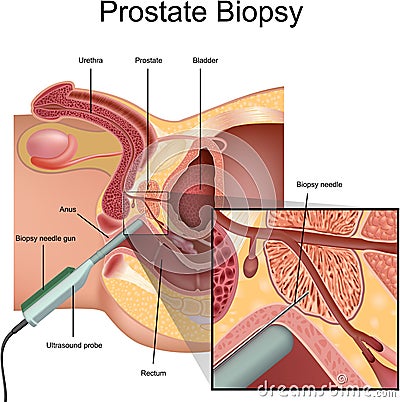 Prostate Biopsy Vector Illustration