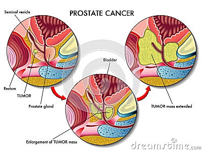 Prostate Cancer Vector Illustration