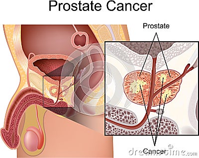 Prostate Cancer Vector Illustration