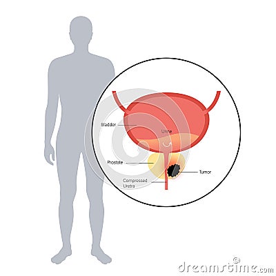 Prostate cancer concept Vector Illustration