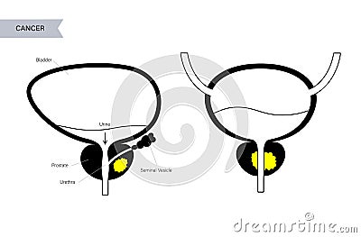 Prostate cancer concept Vector Illustration