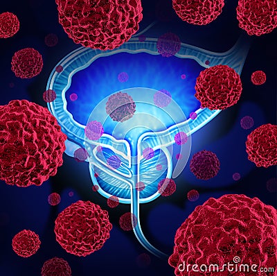 Prostate Cancer Stock Photo