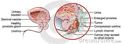 Prostate cancer and healthy prostate, medically accurate illustration Stock Photo