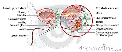 Prostate cancer and healthy prostate, medically accurate illustration Stock Photo