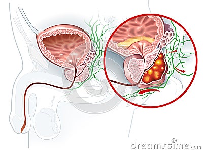 Prostate cancer and healthy prostate, medically accurate illustration Stock Photo