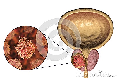 Prostate cancer, illustration Cartoon Illustration