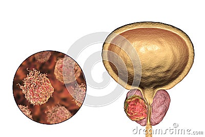 Prostate cancer, illustration Cartoon Illustration