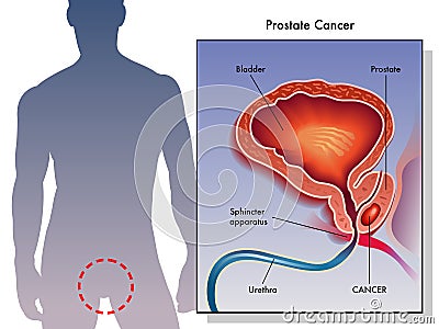 Prostate Cancer Vector Illustration