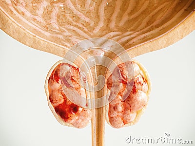 Prostate Cancer Stage 03 of 04 - Detailed High Quality 3D Rendering Stock Photo