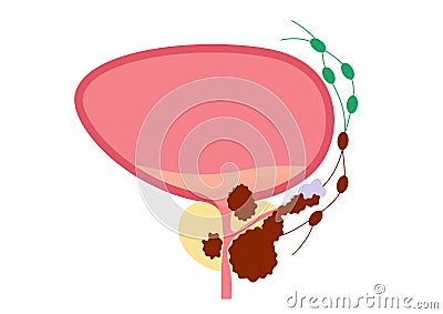 Prostate cancer concept Vector Illustration