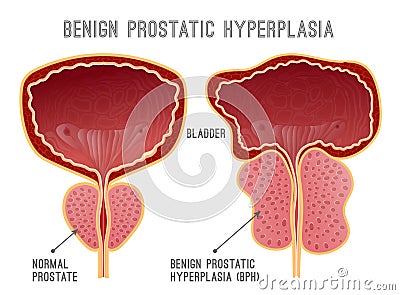 Prostate Disease Infographic Vector Illustration