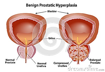 Prostate Enlarged with Benign Hyperplasia Vector Illustration