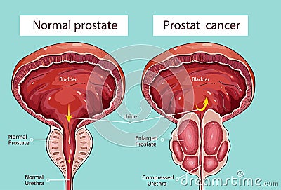 Prostatic hypertrophy Vector Illustration