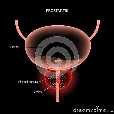 Prostatitis inflammation problem Vector Illustration