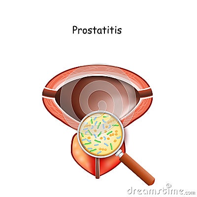 Prostatitis. Male bladder and prostate Vector Illustration