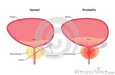 Prostatitis inflammation problem Vector Illustration