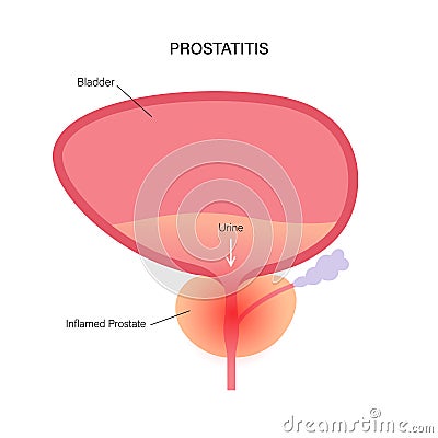Prostatitis inflammation problem Vector Illustration