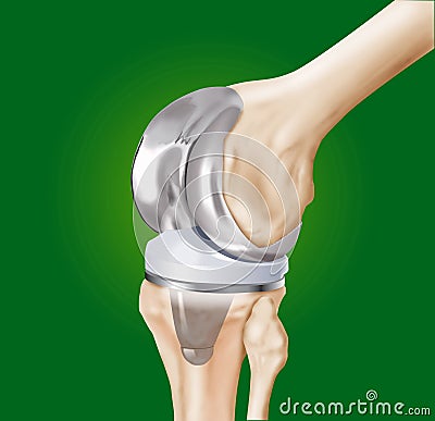 Prosthesis of the knee surgical Stock Photo