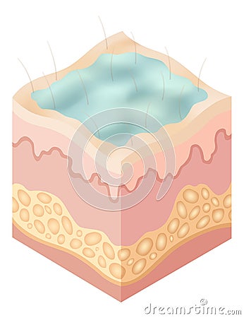 Protection uv ray skin. Illustration about Skin care concept. Sun protection body adipose layers epidermis, vector Vector Illustration