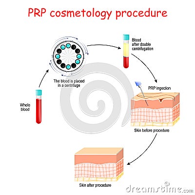 PRP cosmetology procedure. test tubes and syringe with blood and platelet-rich plasma Vector Illustration