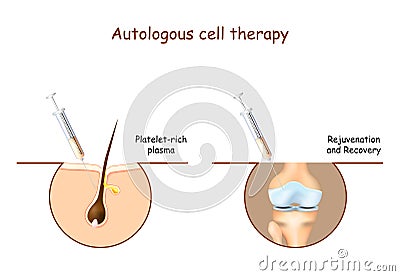 Prp. Platelet-rich plasma. Autologous cell therapy Vector Illustration