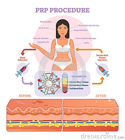 PRP Procedure vector illustration graphic diagram, cosmetology procedure scheme. Vector Illustration