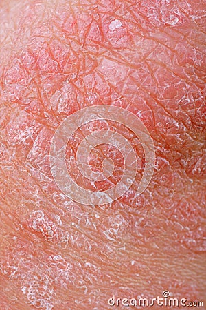 Psoriasis Stock Photo