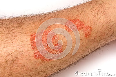 Psoriasis. Alergic rashes on the skin close up. The concept of t Stock Photo