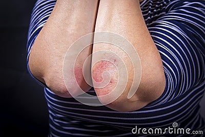 Psoriasis on elbow Stock Photo