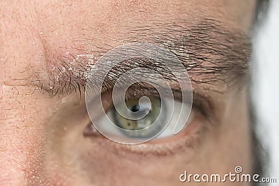 Psoriasis on the eyebrow close up, dermatological diseases, skin problems Stock Photo