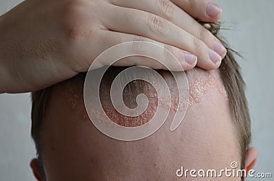 Psoriasis on the skin close-up, scalp, photos of dermatitis and eczema, skin problems, dermatology Stock Photo