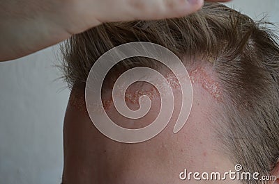 Psoriasis on the skin close-up, scalp, photos of dermatitis and eczema, skin problems, dermatology Stock Photo