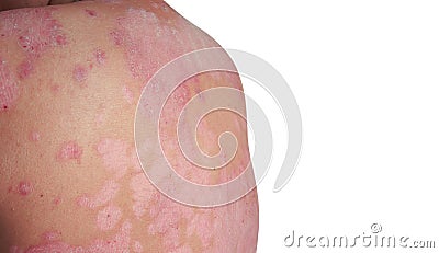 Psoriasis is a skin disease Stock Photo